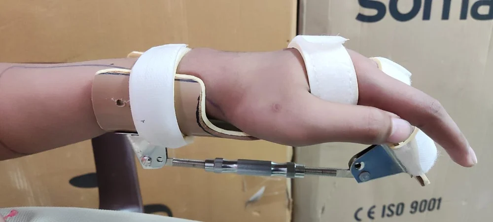 Splint 3