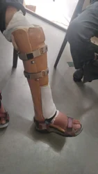 Patellar Tendon Bearing (PTB) Offloading Fracture Brace System