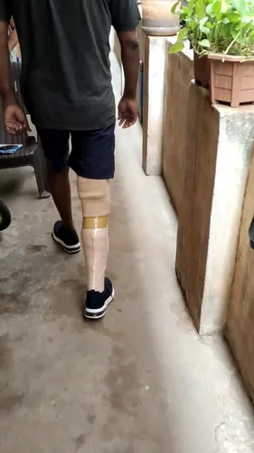 Below Knee Prosthesis – Singar Rehab