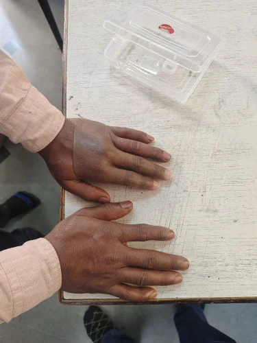 Body-Powered Artificial Fingers Prosthesis – Singar Rehab