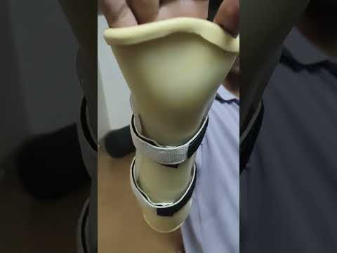 Rehabilitation Splints Video - Singar Rehab